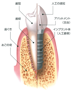 インプラント