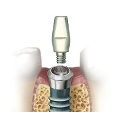 アバットメント（支台）の装着