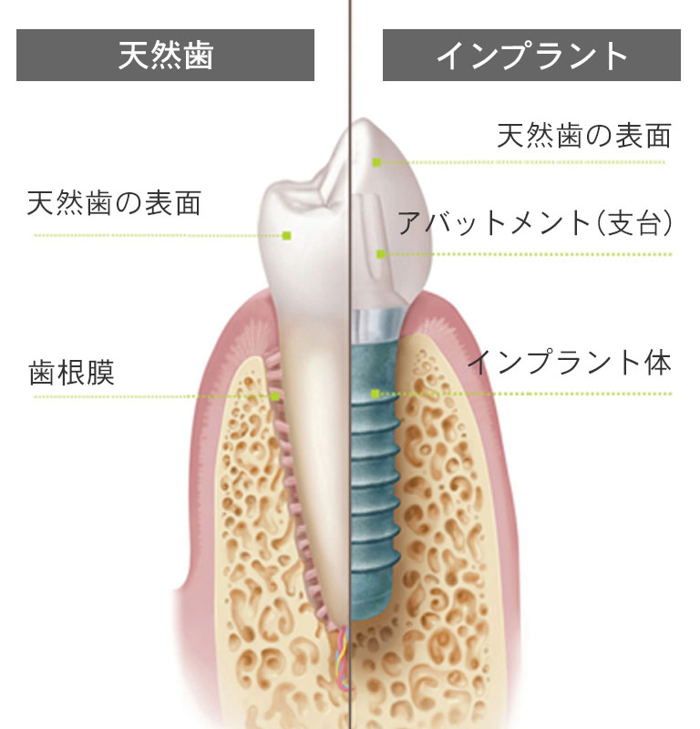 インプラント