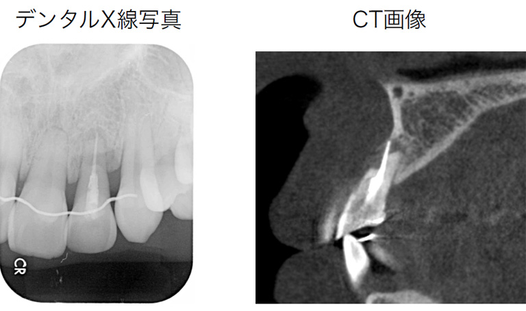 CTとデンタルX線写真