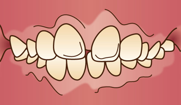 上顎前突（出っ歯）
