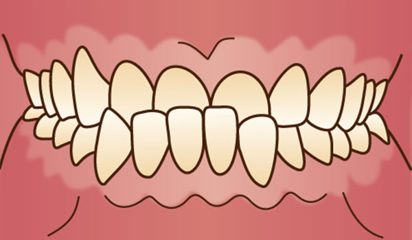 下顎前突（反対咬合・受け口）